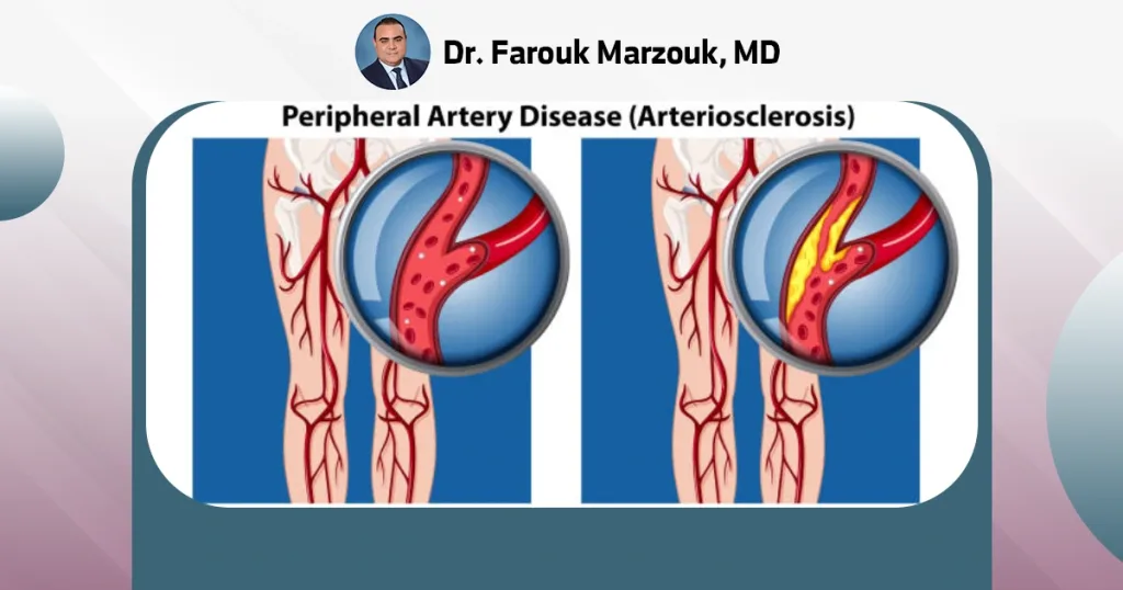 Acute arterial insufficiency | What are the 5 P's of acute arterial insufficiency? Acute arterial thrombosis vs embolism