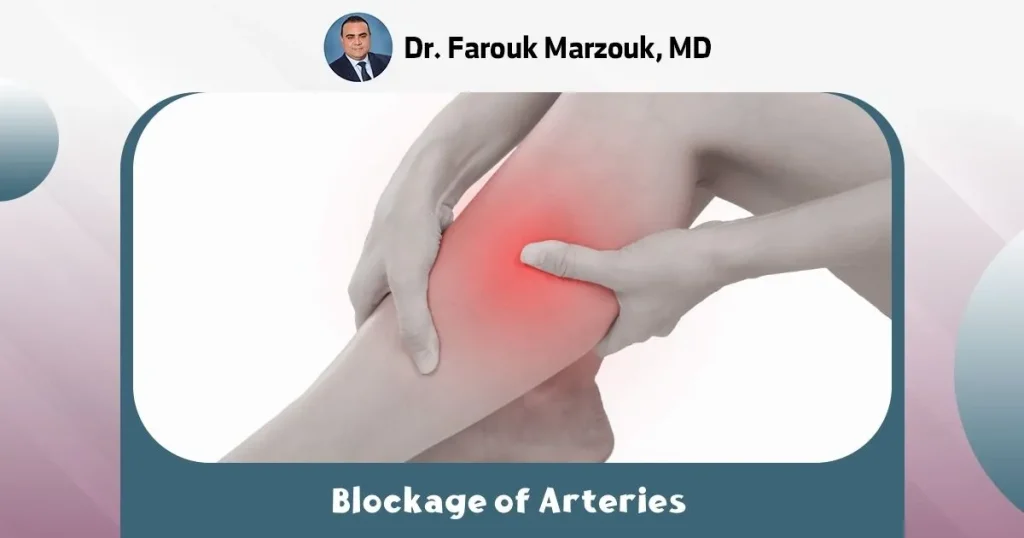 Blockage of arteries in legs | what is the treatment for blocked arteries in the legs ? what is the treatment for blocked arteries in the legs
