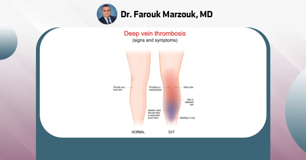 Causes of deep vein thrombosis