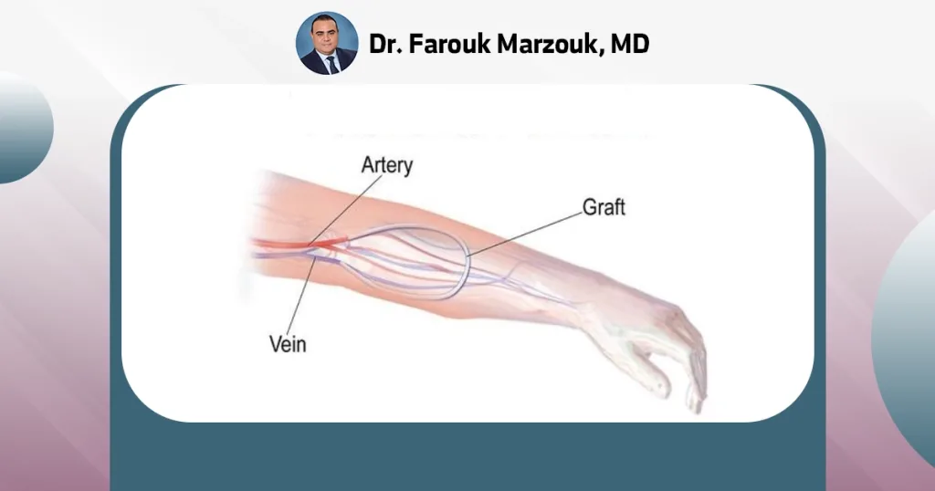 vascular graft