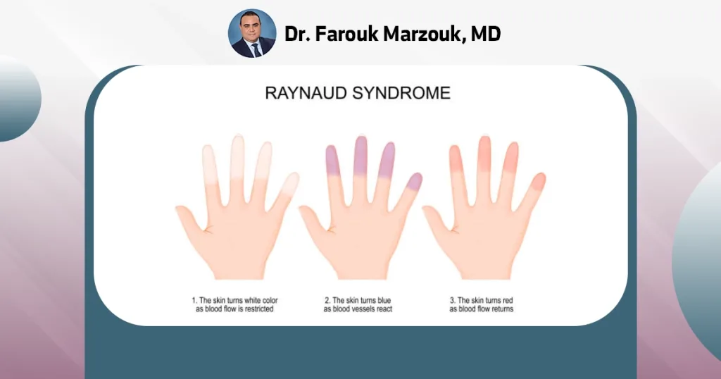 Raynaud's Syndrome What is the life expectancy of Raynaud's syndrome?