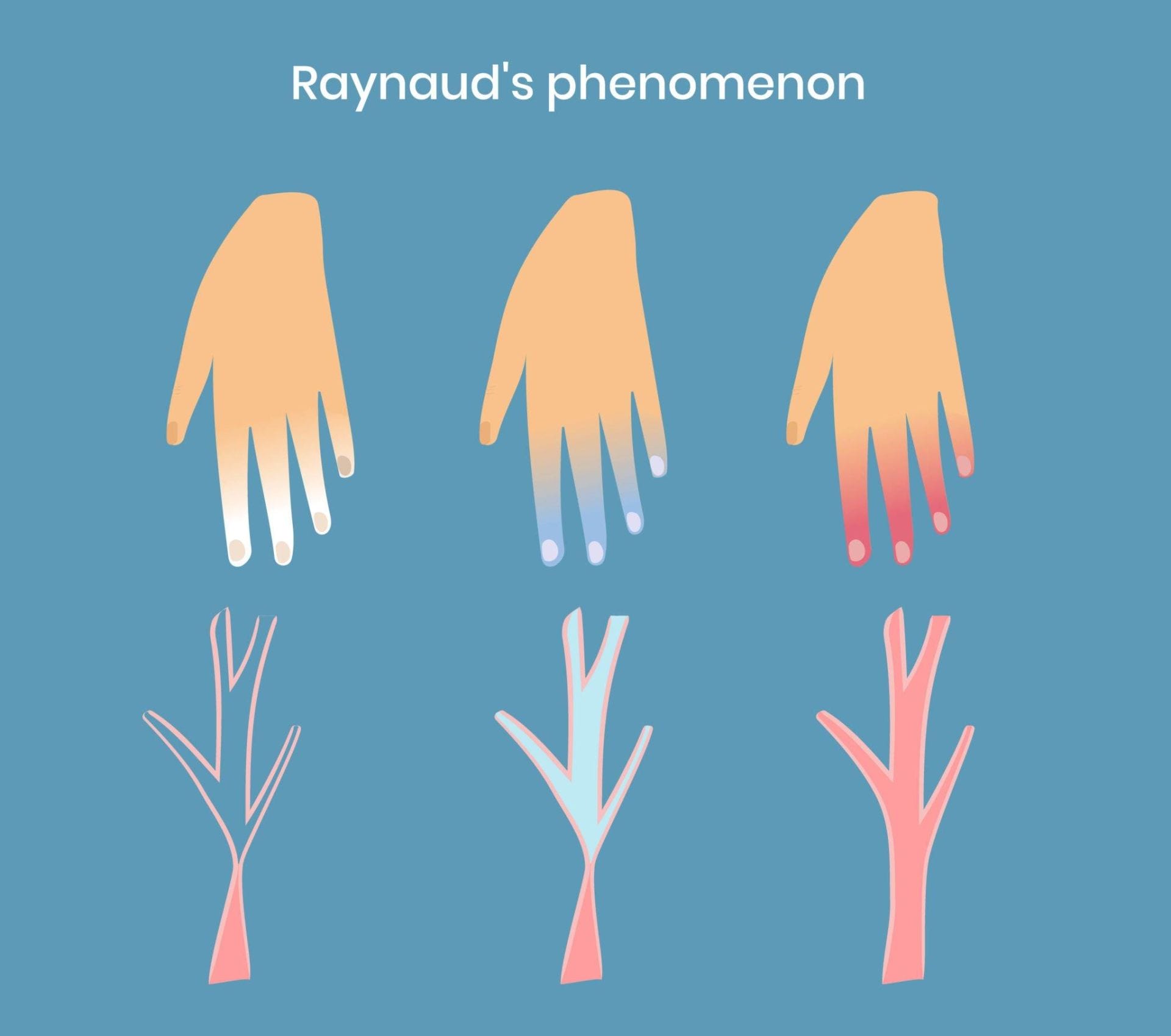 Raynaud's syndrome treatment