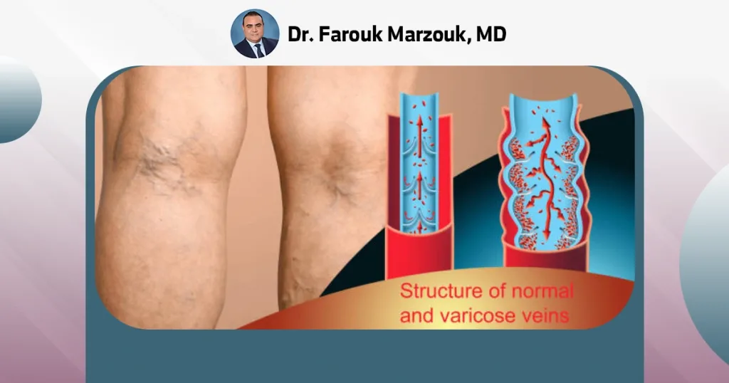 venous ulcer | Effectiveness of revascularization for ulcer healing Causes of venous ulcer
