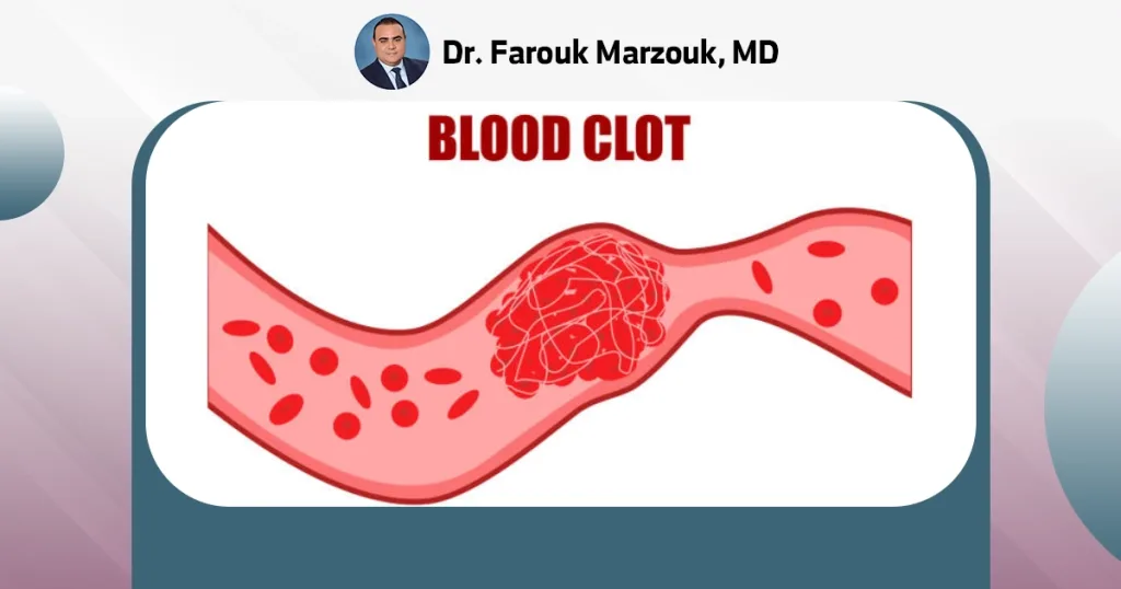 Blood clot | What is the cause of blood clots? What are the first signs of a blood clot?
