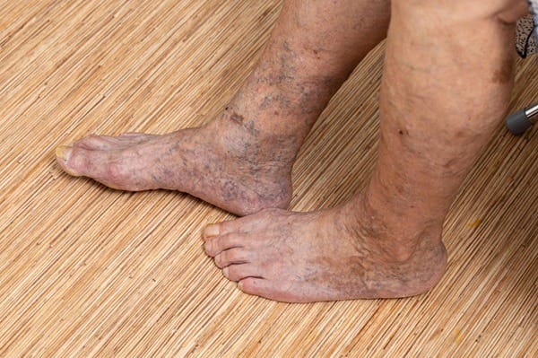 Peripheral vascular diseases | What is the most common peripheral vascular disease? Peripheral artery disease symptoms