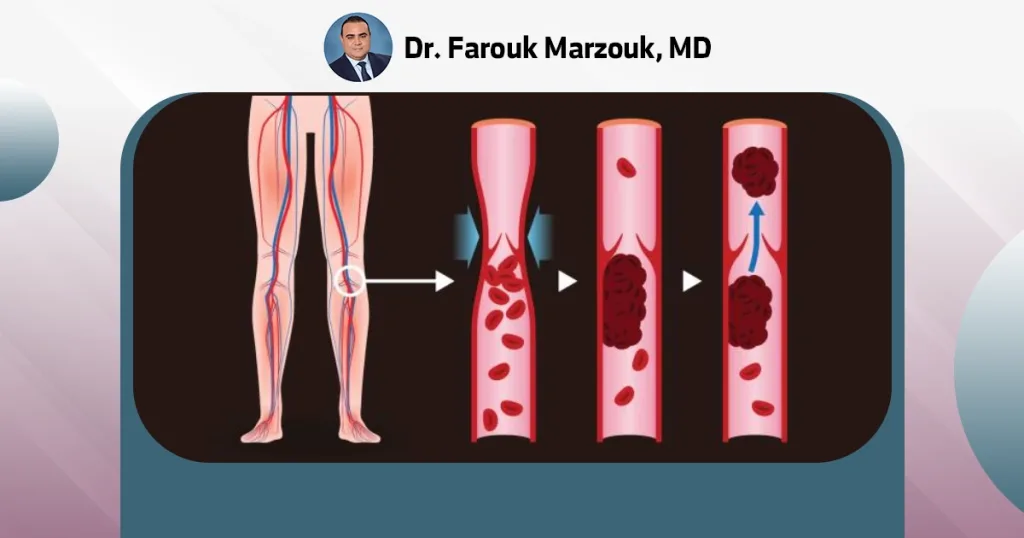 What is the cause of blood clots?