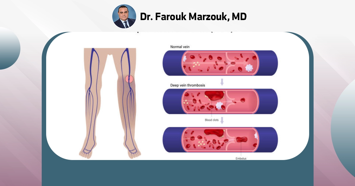 Chronic venous insufficiency