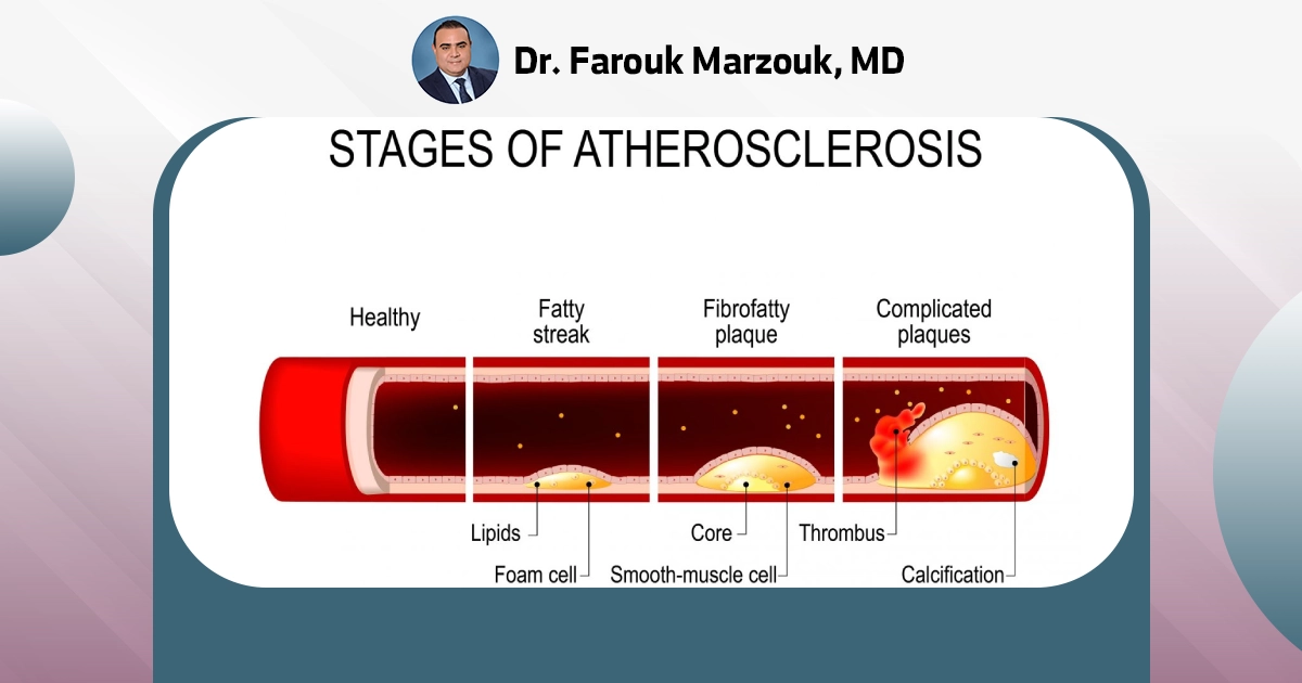 Medical Management of Atherosclerosis Vascular Disease