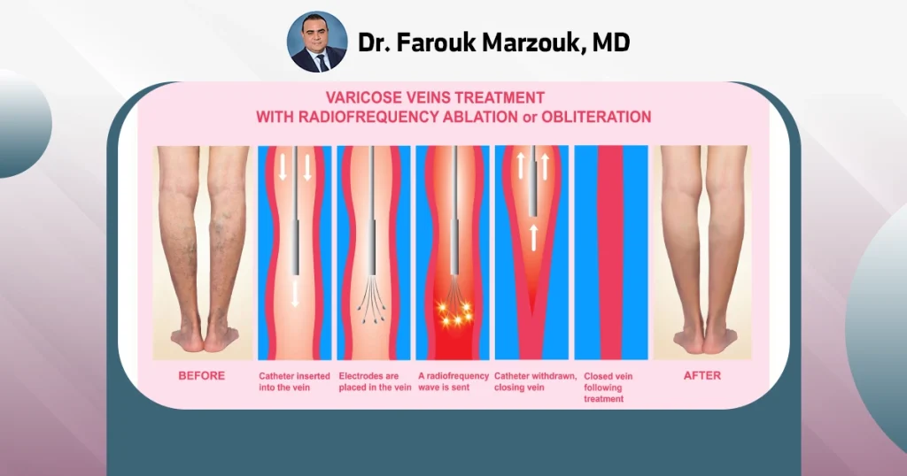 What is the best treatment for spider veins? Spider vein therapy