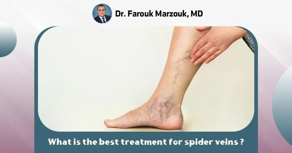 What is the best treatment for spider veins