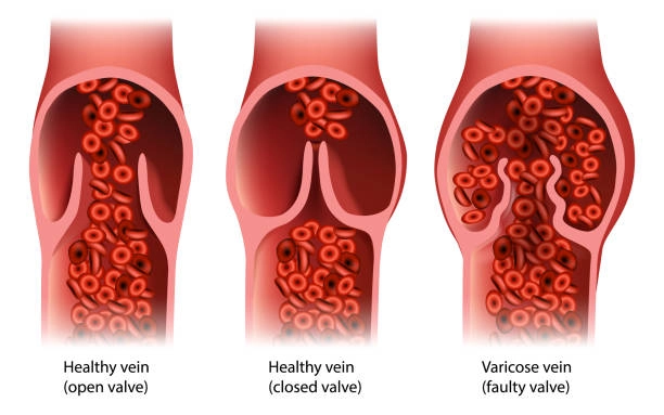 Chronic venous insufficiency What is stage 3 of chronic venous insufficiency?