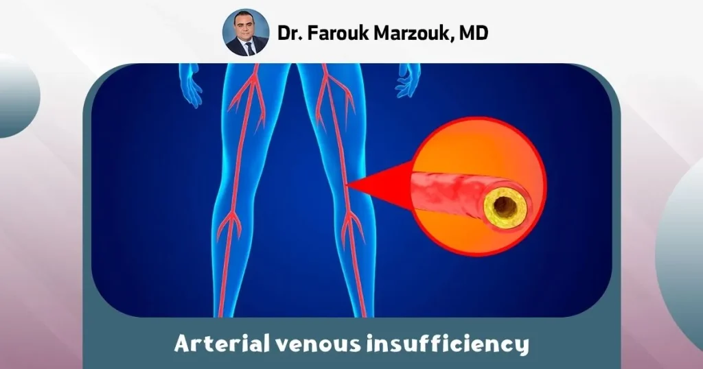 Arterial venous insufficiency