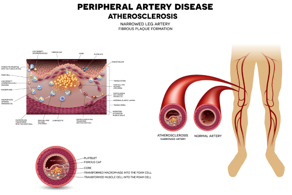 Complication of atherosclerosis