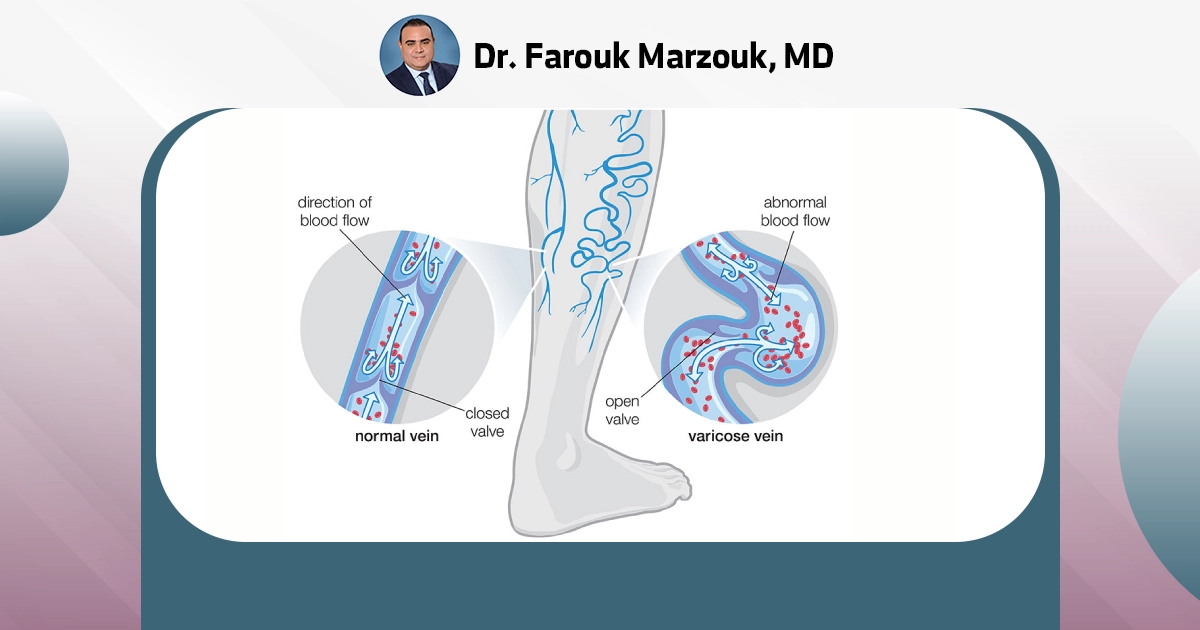Varicose vein therapy | What treatments are there for varicose veins?