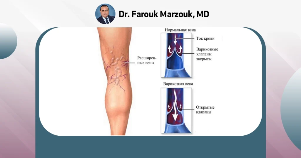 Can you stop varicose veins?