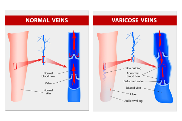 Varicose veins treatment 