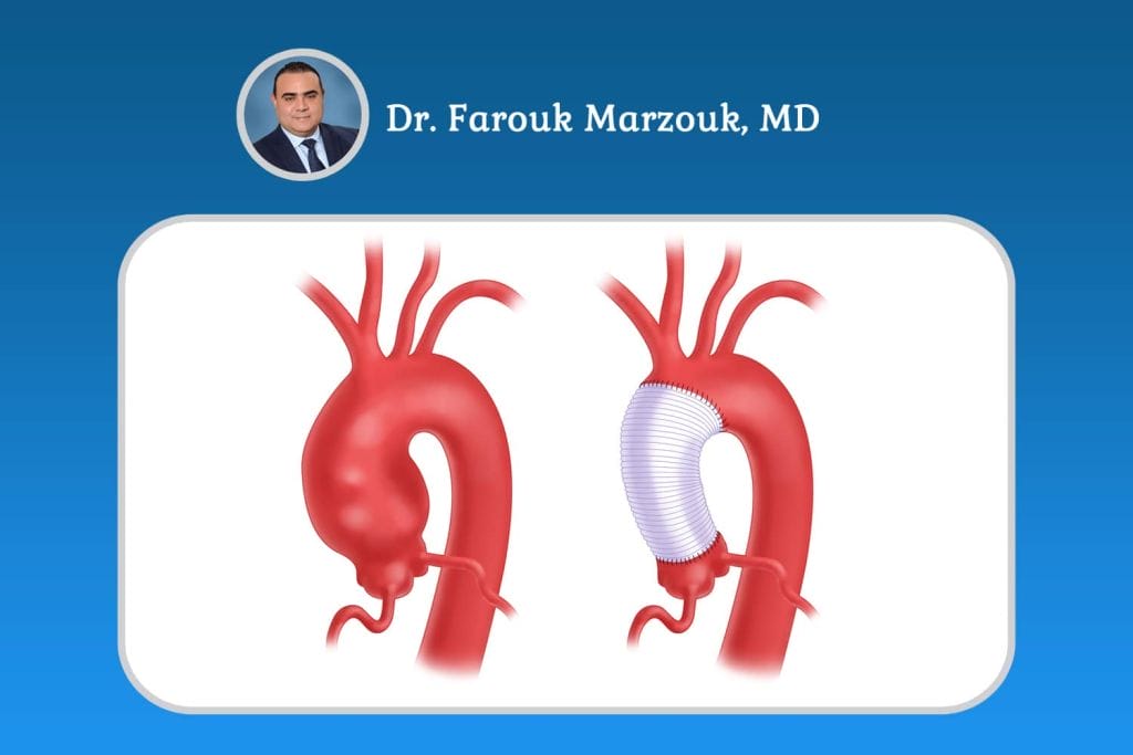 How Dangerous Is a 4 cm Aortic Aneurysm?