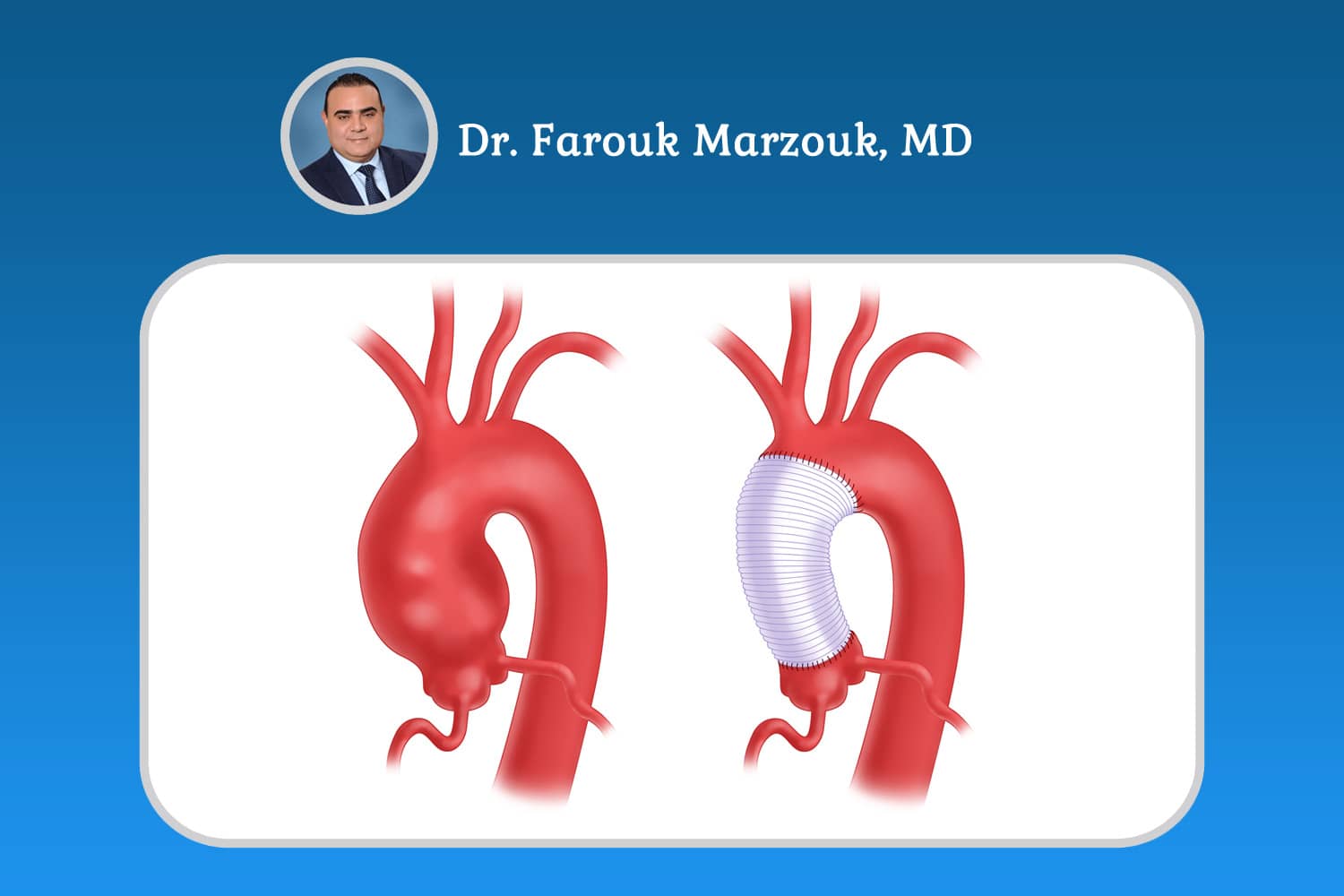 How Dangerous Is a 4 cm Aortic Aneurysm?