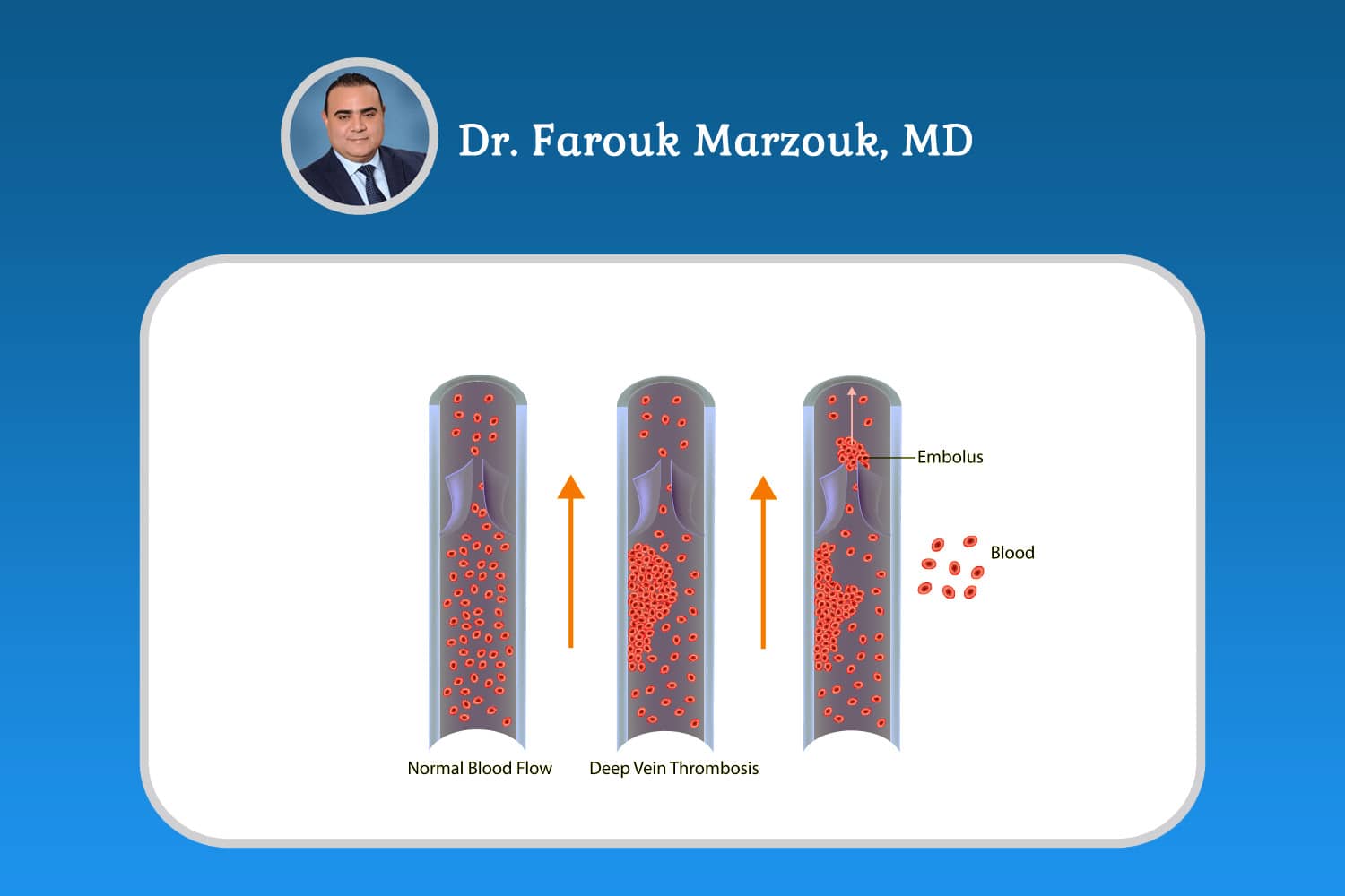 Deep Vein Thrombosis (DVT) Treatment