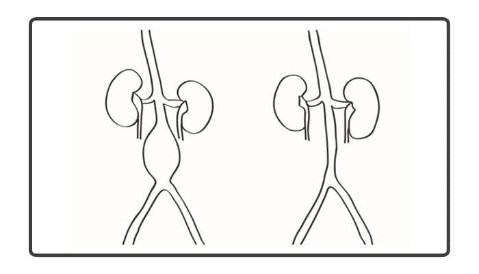 How Dangerous Is a 4 cm Aortic Aneurysm? 4 cm Aortic Aneurysm