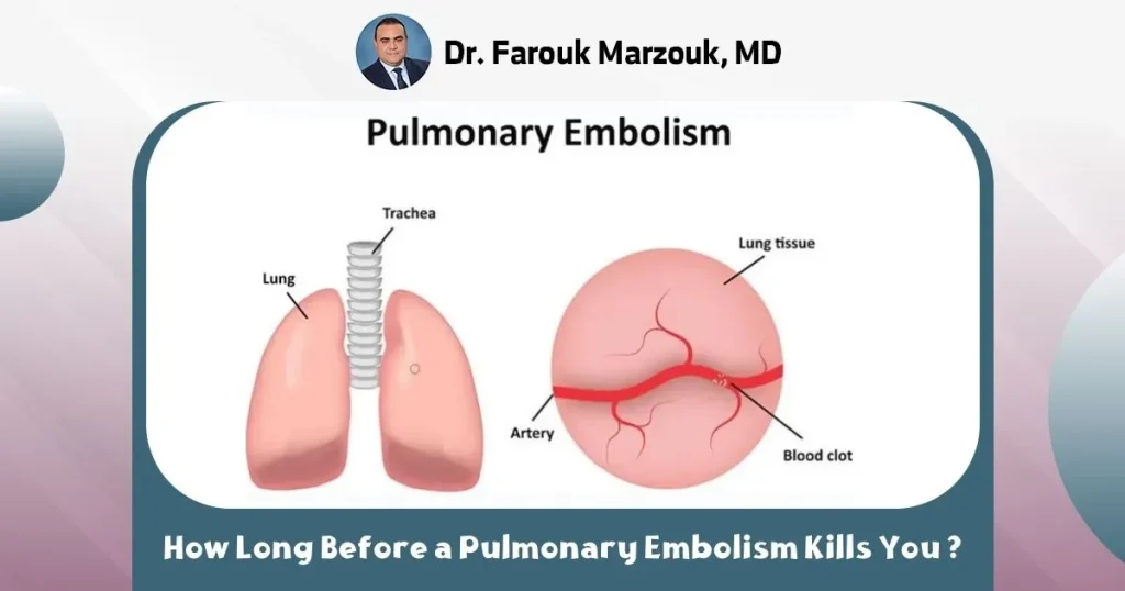 How Long Before a Pulmonary Embolism Kills You