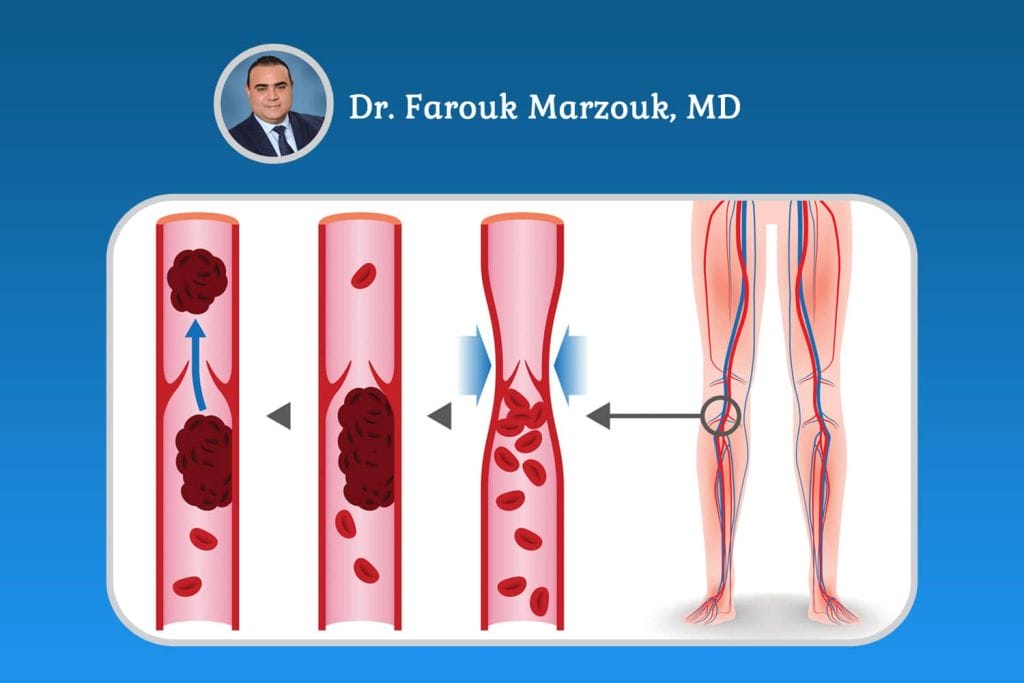 How to Check for a Blood Clot in Your Leg