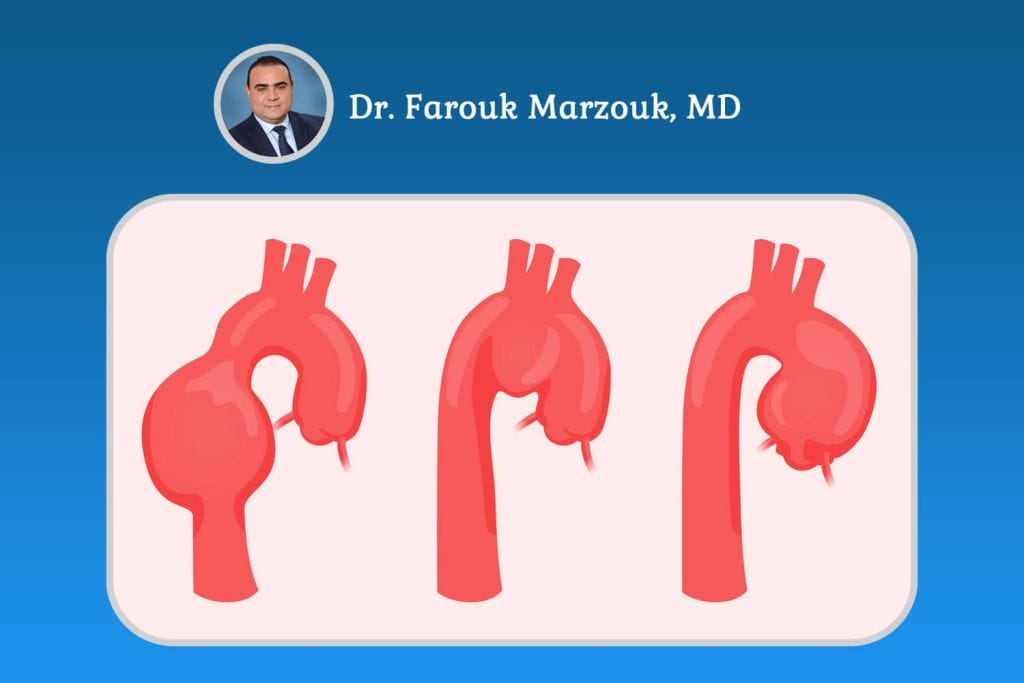 Aortic Aneurysm in Females Symptoms