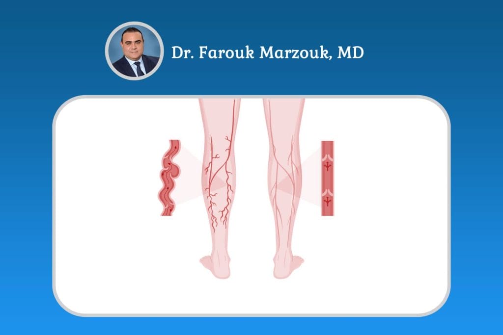 Varicose Veins in One Leg Only - Causes and Treatments