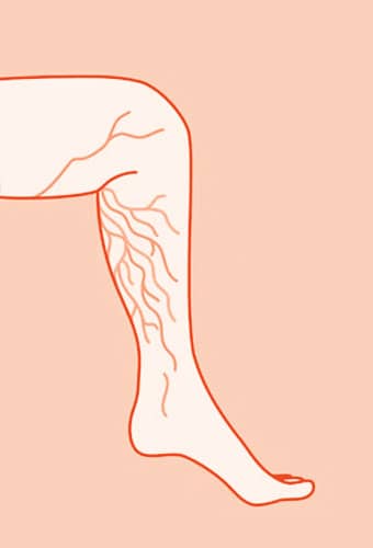 Varicose Veins in One Leg Only Varicose Veins in One Leg Only