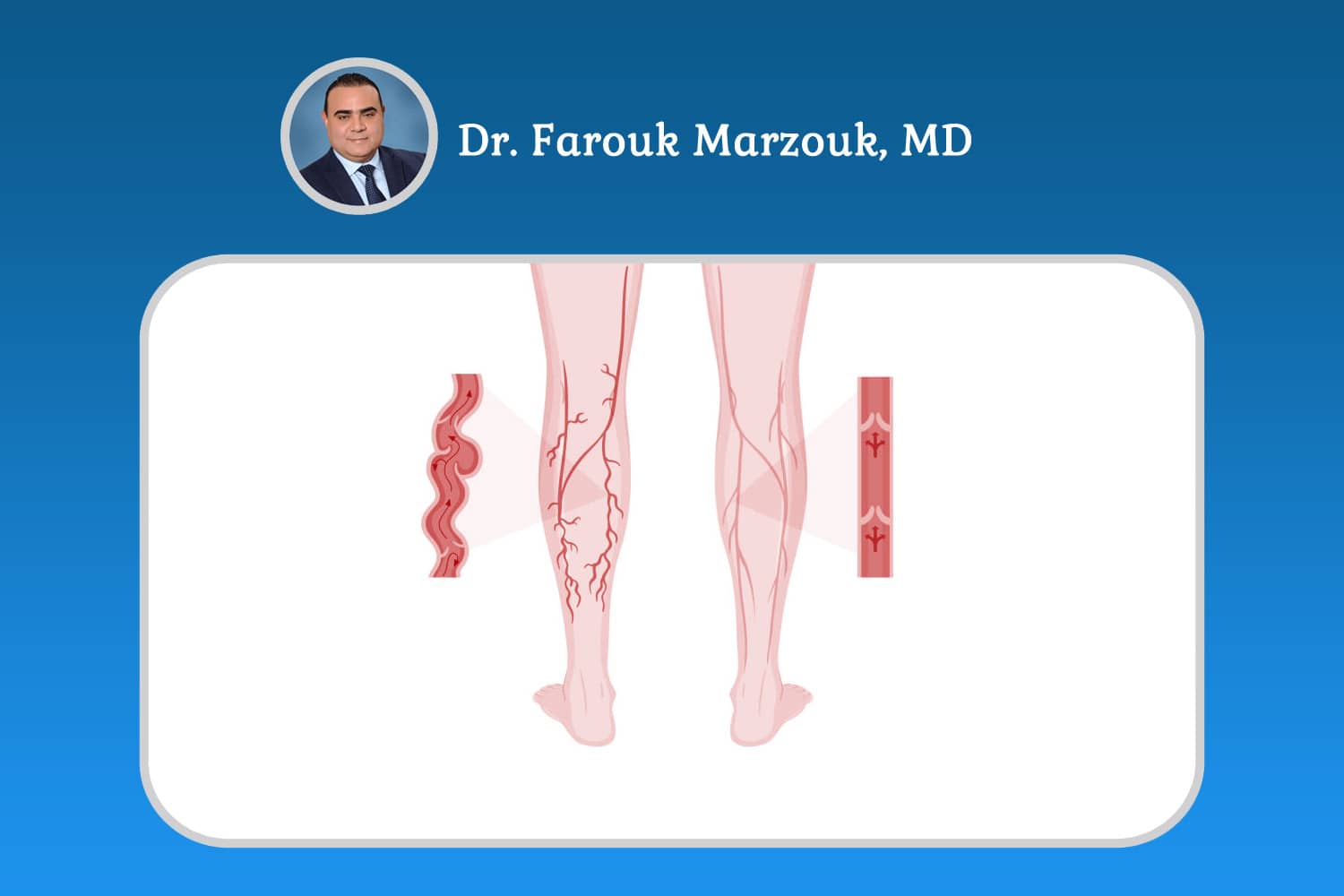 Varicose Veins in One Leg Only