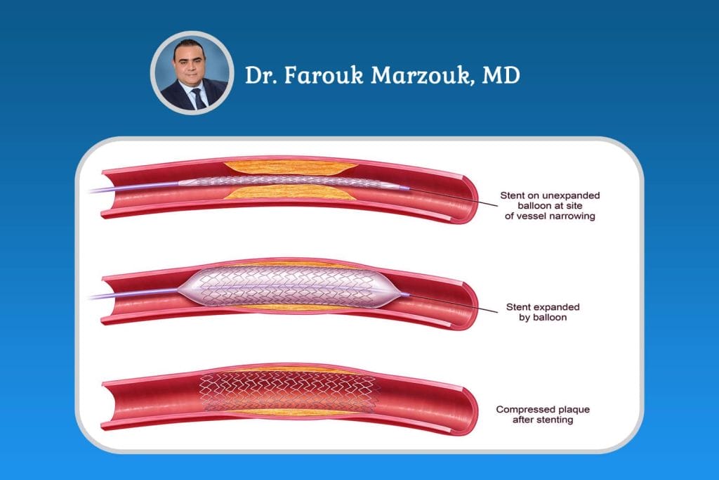 Balloon Angioplasty vs Stent