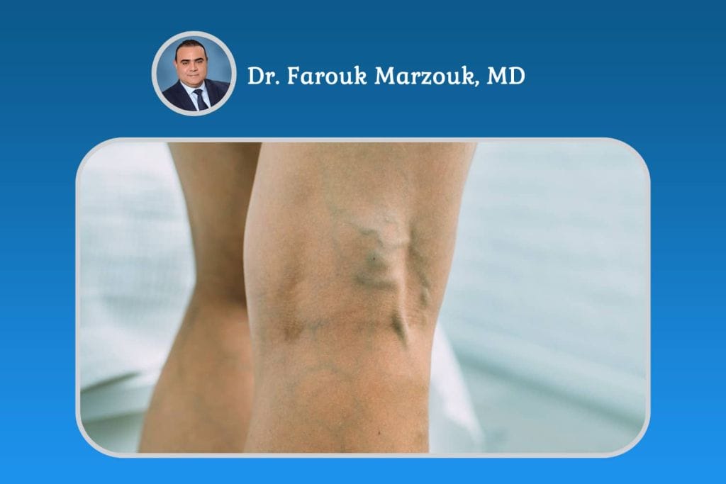 Deep Vein Thrombosis Behind Knee, blood clot behind knee