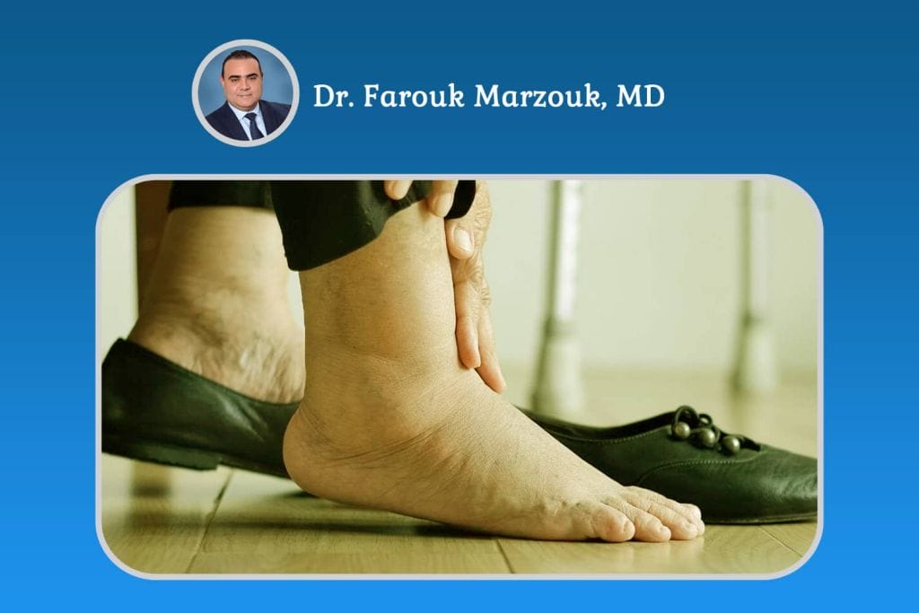 Swelling in Legs Home Remedies