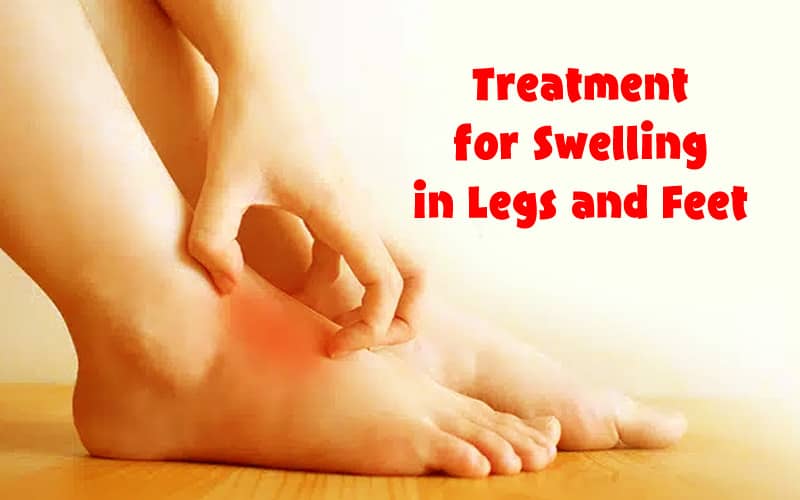 Treatment of Swelling in Legs and Feet