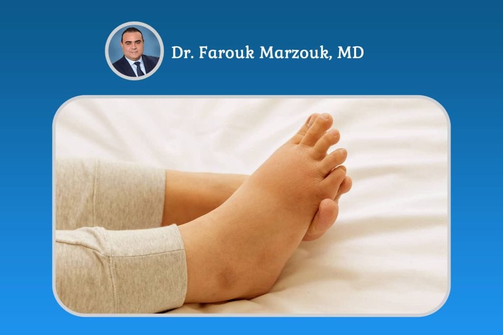 Treatment for Swelling in Legs and Feet