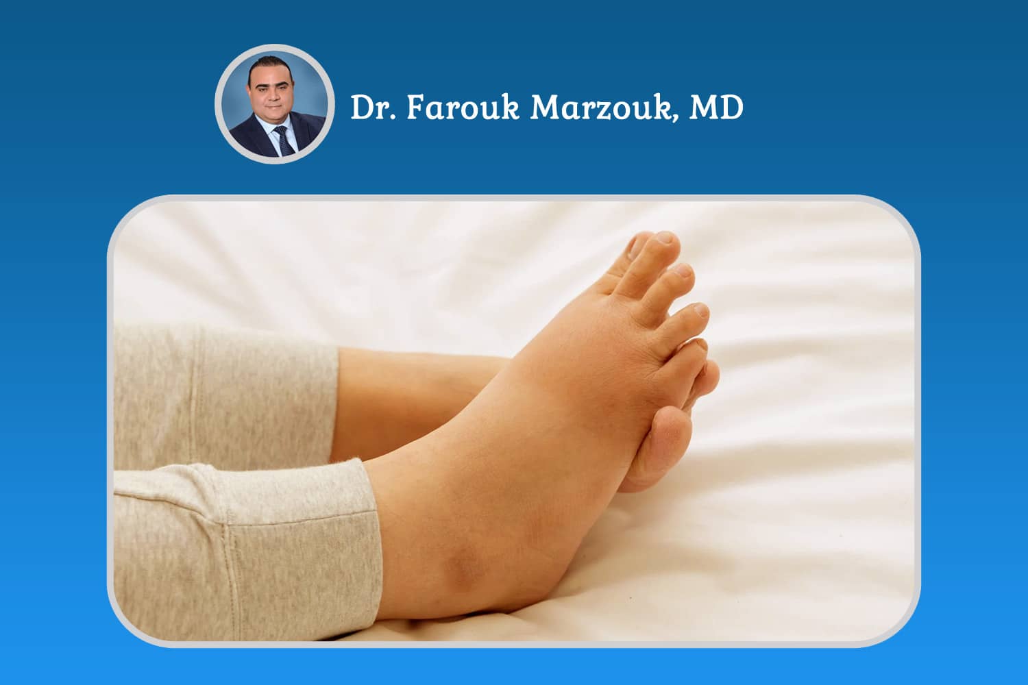 Treatment for Swelling in Legs and Feet