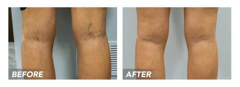 How long does it take spider veins to go away after laser ?