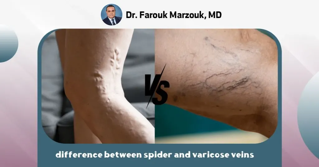 difference between spider and varicose veins