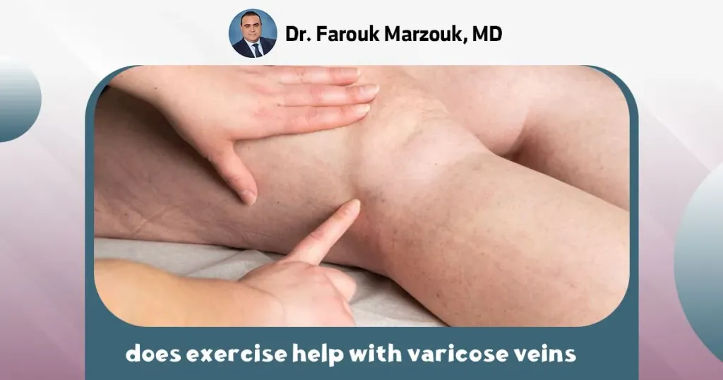 does exercise help with varicose veins ?