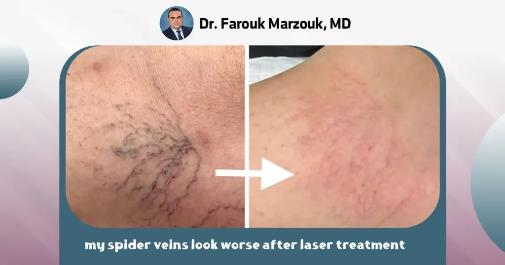my spider veins look worse after laser treatment