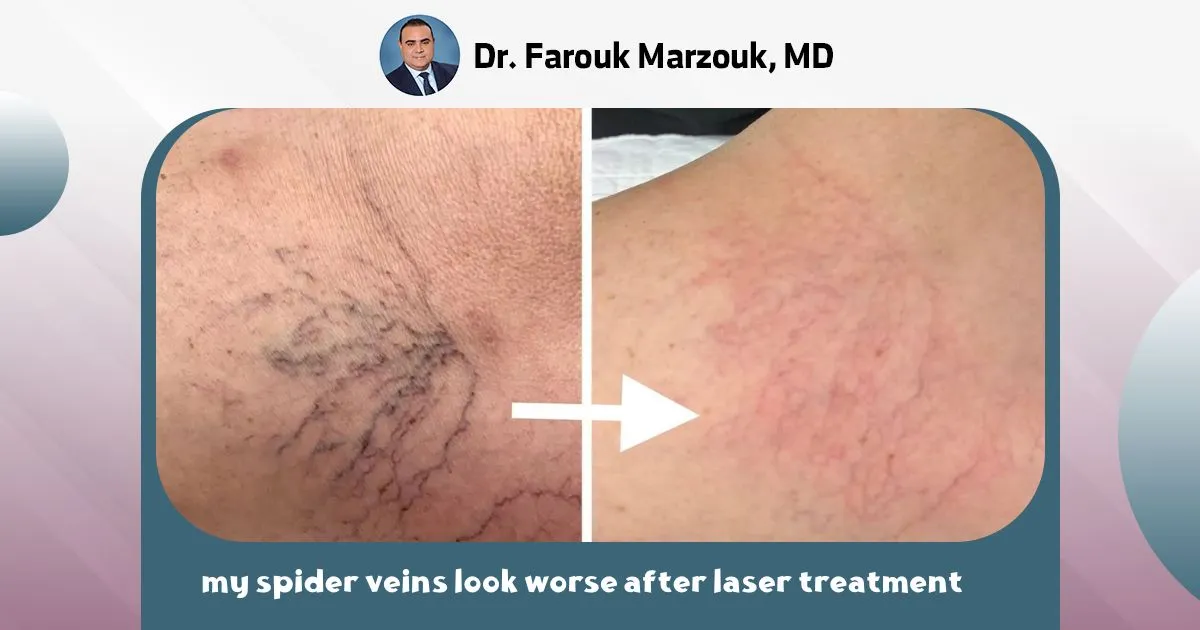 Why do my spider veins look worse after laser treatment ?