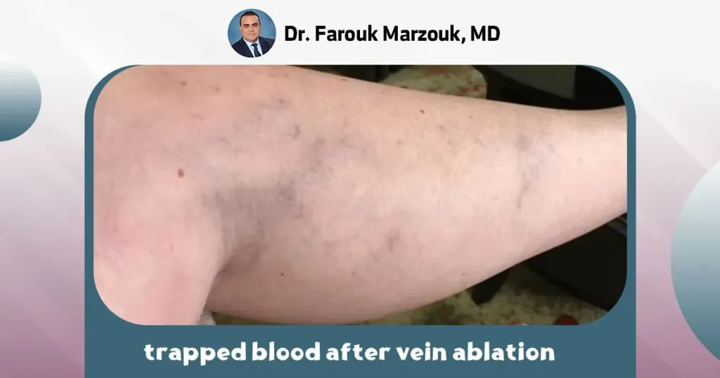 trapped blood after vein ablation