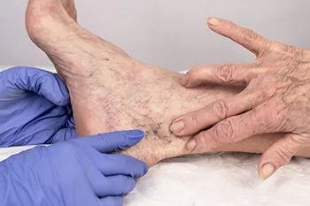 Diagnosis How Blood Clots Are Confirmed