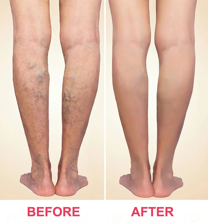 Varicose Veins Laser Treatment Before and After Things to Avoid After Laser Vein Treatment