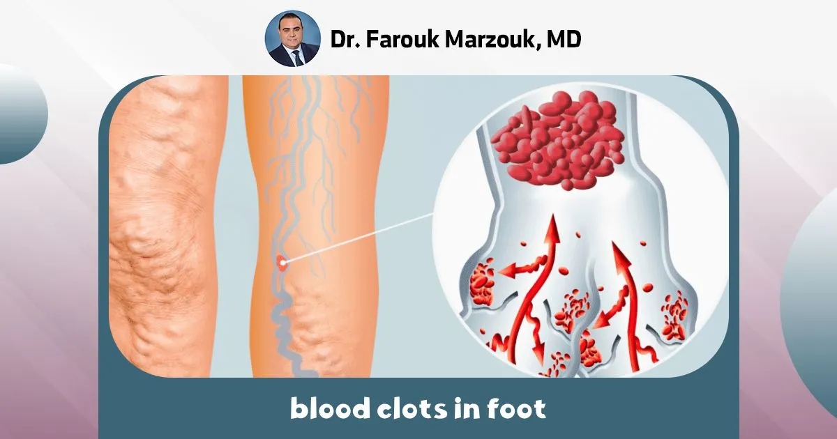 blood clots in foot: Symptoms, Risks and When to Seek Help