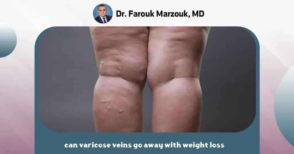 can varicose veins go away with weight loss