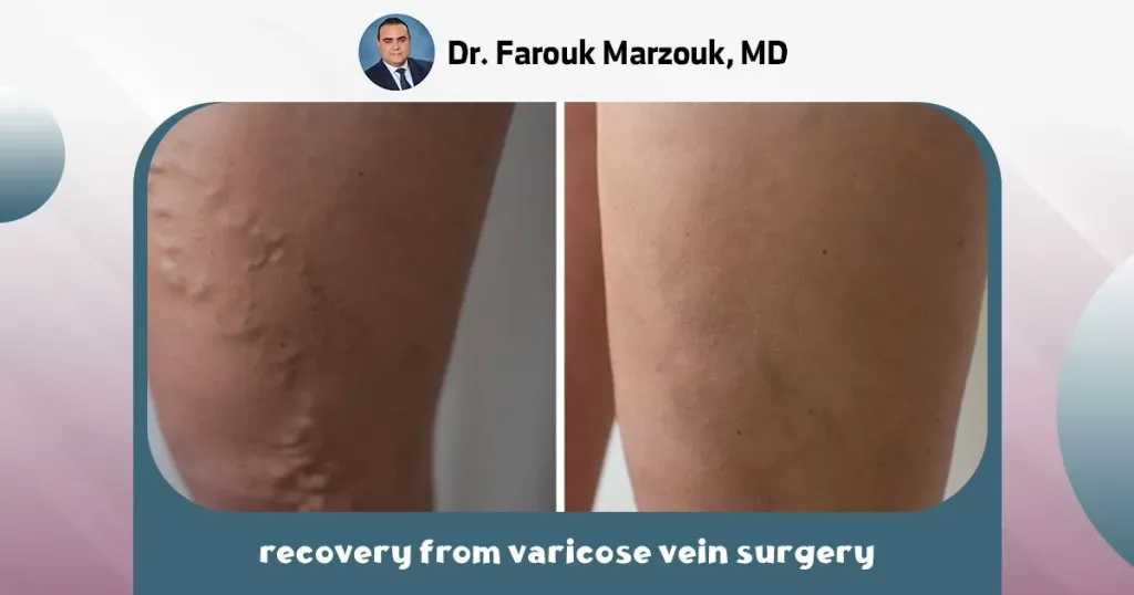 recovery from varicose vein surgery
