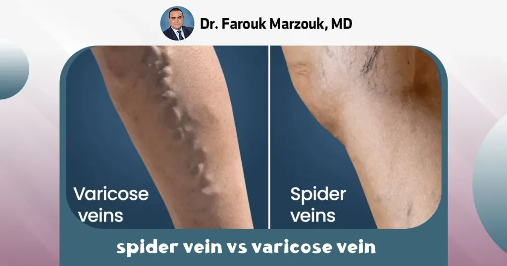 spider vein vs varicose vein