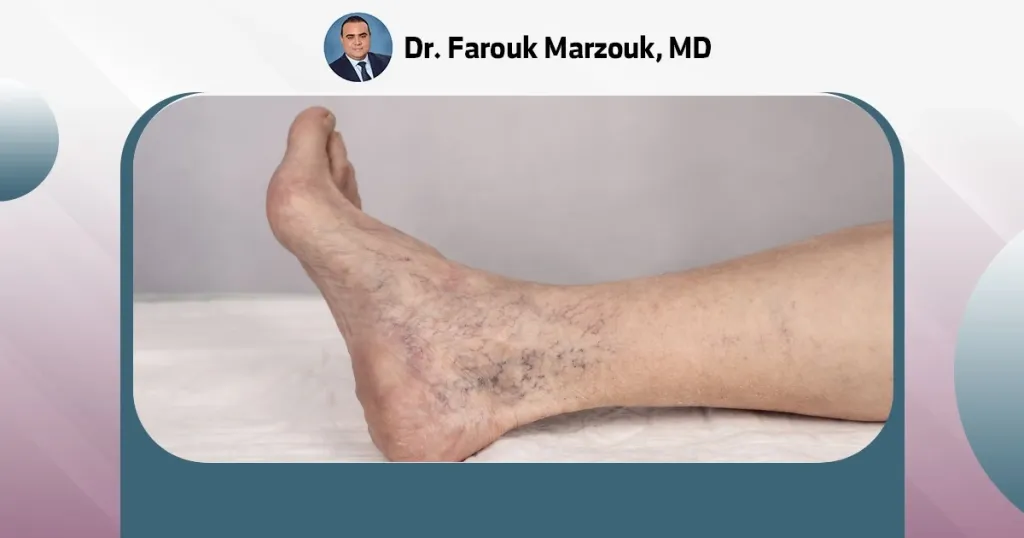 Can Varicose Veins Go Away With Weight Loss