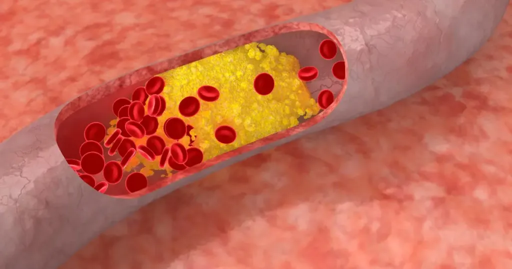 Is Peripheral Arterial Disease Reversible? Full Guide Slowing PAD Progression